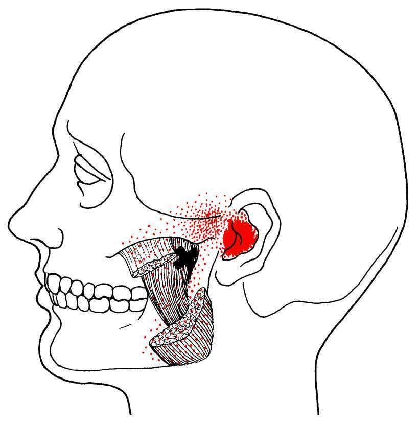 Deep Masseter TrP