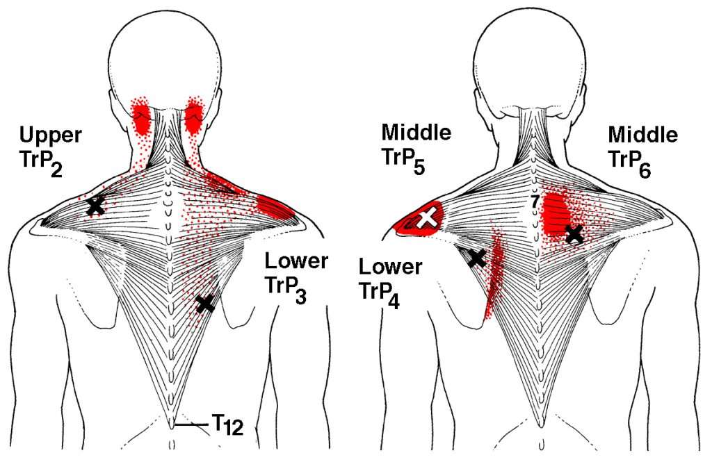 Trapezius TrP